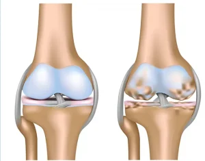 остеоартроз коленного сустава